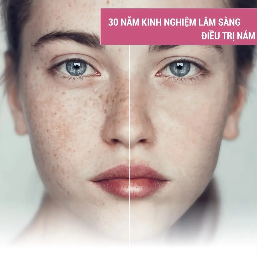 kem-tanit-plus-15ml-giai-phap-mo-tham-nam-chuyen-biet-xoa-sach-dom-nau-tan-nhang-tan-goc-10.webp